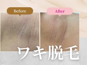 フェルナ 上新庄店(FERNA)/ワキ脱毛
