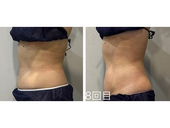 ラヴィエール(Laviere)/【レディース痩身120分】8回目