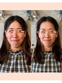 ハリトト鍼灸院/美容鍼灸 施術例 30代女性