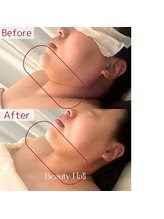 サロンドカモン(salon de 華門)/新コースREDSHOT二重あご症例