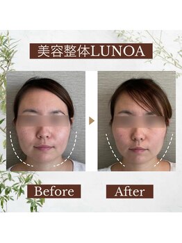 ルノア 梅田院(LUNOA)/小顔矯正[梅田/小顔/エラ張り]