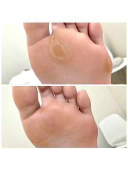 りく/角質ケア45分