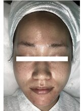 ヴィヴ 熊本(ViV)/【セルマンピーリング】before