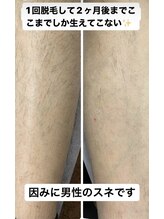 エピラージュ 町田店/全身脱毛