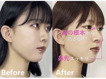 ラプリ 大宮店(Raplit)/隆鼻＋輪郭矯正40分10回
