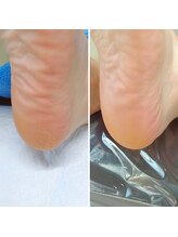 ドクターネイル爪革命 小田原鴨宮店/角質ケア（スクラブ付き）