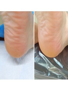 ドクターネイル爪革命 小田原鴨宮店/角質ケア（スクラブ付き）