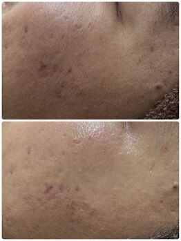 アレーズファイブフォー(A’LAISE54)/ニキビケア