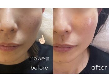 ロージースマイル(Rosy smile)/【韓国肌管理★ セラピール 】