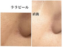 ティアラ(TIARA)/ララピール　