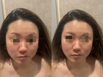 骨気(コルギ)専門店 YONG miu【ヨング ミュー】/小顔コルギ【before after】