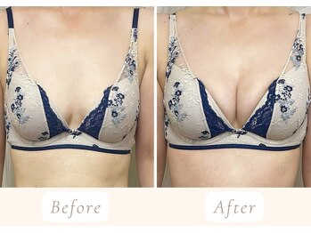 ノルン(Norn)/40代育乳バストアップ(5回目)