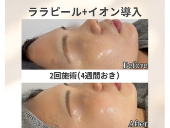 イーラボ 池袋店(e-LABO)/韓国肌管理/ララピール