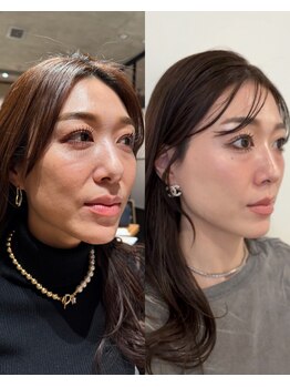 ヒメミ(Himemi)の写真/インセルダムで小顔・たるみ改善！毛穴の開き、フェイスラインをスッキリ◎