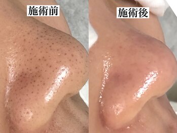 エミナル(eminal)/ビフォー/アフター/毛穴/梅田