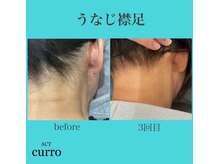 アクト クロ(ACT curro)/【うなじ襟足】脱毛施術例
