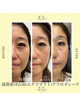 アフロディーテ(Aphrodite)/エクソリフト