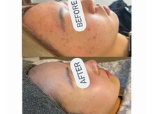 アンド(&.)の雰囲気(肌荒れ、ニキビケア)