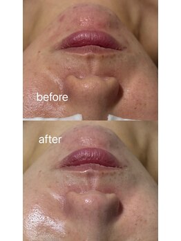 リル(LIL by lum)/名古屋/毛穴洗浄/セラピール