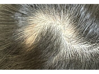 命水鍼灸院/育毛促進【新宿/鍼灸】