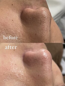 チル(chill)/ビフォーアフター