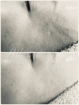 エルール トータルビューティ(Aileure total beauty)/肌質改善　ララピール