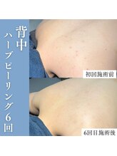 エミーニー(emiiny)/背中ハーブピーリング