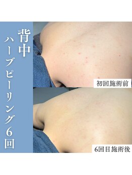 エミーニー(emiiny)/背中ハーブピーリング