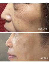 ミミルーチェ(mimiluce)/クレアスキンケア使用で肌質改善