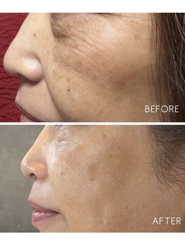 ミミルーチェ(mimiluce)/クレアスキンケア使用で肌質改善