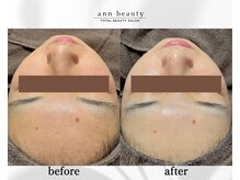 アン ビューティー(ann beauty)/施術2回【症例写真】20代