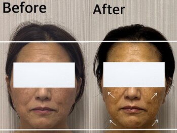 ベール(BEHL)/コルギのBeforeと4回施術後