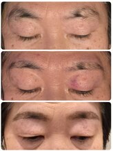 ベビースキン(baby skin)/美容電気脱毛