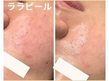 アンブル(Ambre)/ララピール