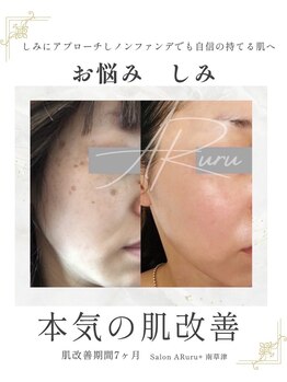 アルルプラス 南草津(ARuru+)/【肌改善】ビフォーアフター