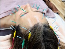 トゥルーカラーズの雰囲気（美容鍼と本格フェイシャルエステ技術のダブル効果）