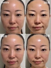 ユニ(Uni)/インセルダム　使用１週間の変化