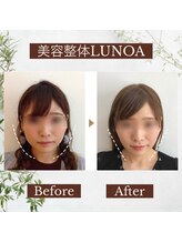 ルノア 梅田院(LUNOA)/小顔矯正[梅田/小顔/エラ張り]