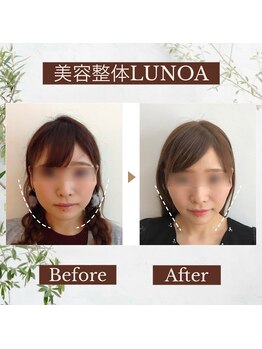 ルノア 梅田院(LUNOA)/小顔矯正[梅田/小顔/エラ張り]