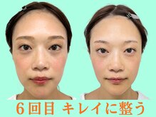 ナチュラルパーフェクトフェイス 新宿/6回目理想の小顔に/新宿小顔矯正