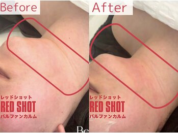 パルファンカルム 駅西本町店/フェイスラインをスッキリ!