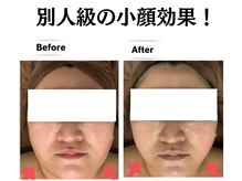 グレースティー 森町 箕面/たるみ改善★別人級の小顔に！