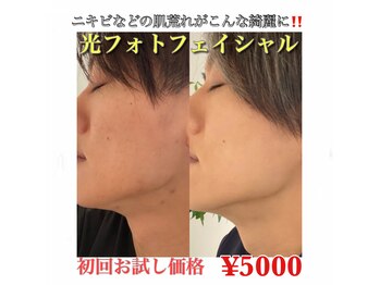 リノア 心斎橋店(LINOAH)/美肌フェイシャル