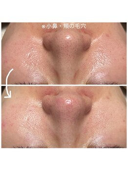 ルーナ(Luna)/WiQo水光肌ピール