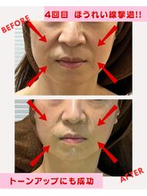 ユーフォリア(Euphoria)/ほうれい線撃退　+　小顔効果