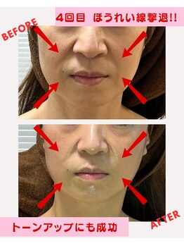 ユーフォリア(Euphoria)/ほうれい線撃退 + 小顔効果