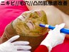 ニキビケア//毛穴//小顔//凸凹改善⇒ エステ版の微細針 ¥12800先着10名様限定