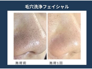 アポロ(Apollo)の写真/《メンズ専門サロン◇大人気の毛穴ケア◎》黒ずみ角栓/毛穴汚れを徹底ケア!詰まった毛穴をゴッソリ洗浄♪