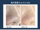 アポロ(Apollo)の写真/《メンズ専門サロン◇大人気の毛穴ケア◎》黒ずみ角栓/毛穴汚れを徹底ケア!詰まった毛穴をゴッソリ洗浄♪