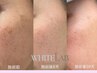 韓国発！はがすシミケア　とり放題　15分　WHITELAB
